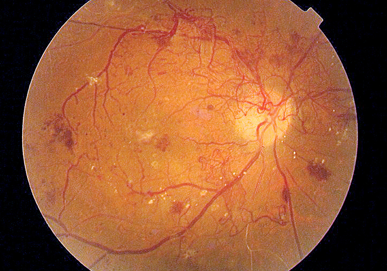 Diabetic eye complications highlighted on World Sight Day